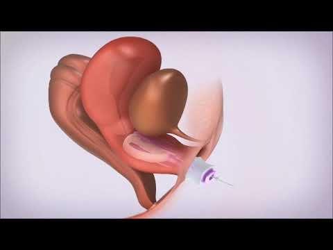 הדמיה ממוחשבת למכשיר המונע בריחת שתן עבור חברת ConTipi